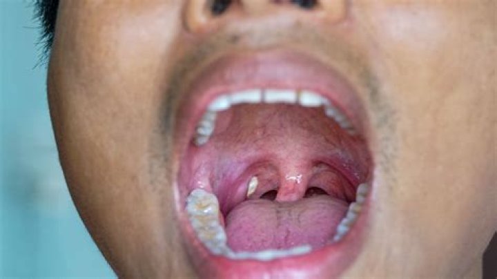 How do I know if I have trench mouth?