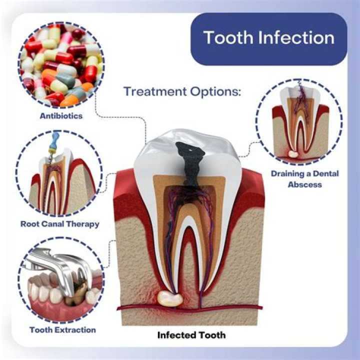 How do I know if tooth is infected?
