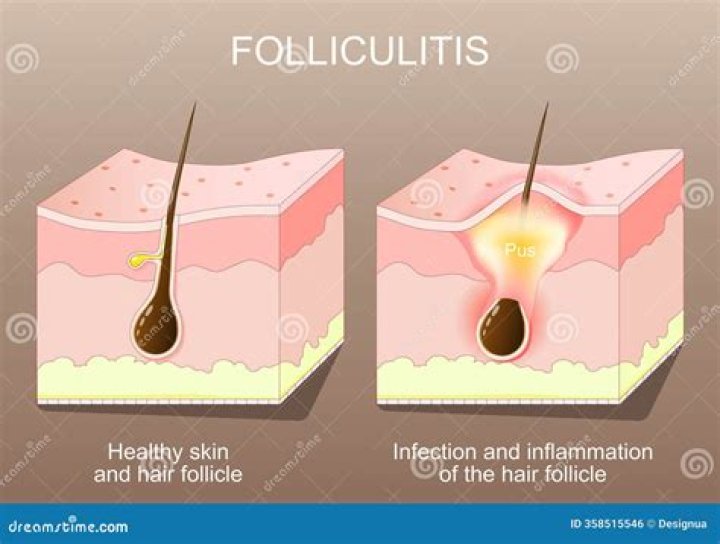 How do I reduce inflammation in my hair follicles?