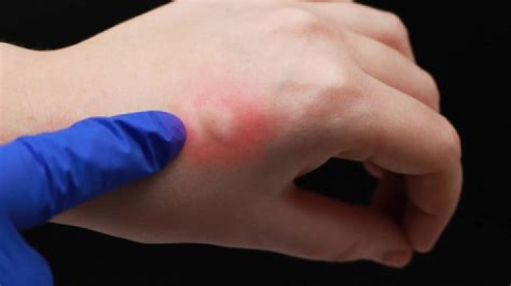 How do nipples get infected?