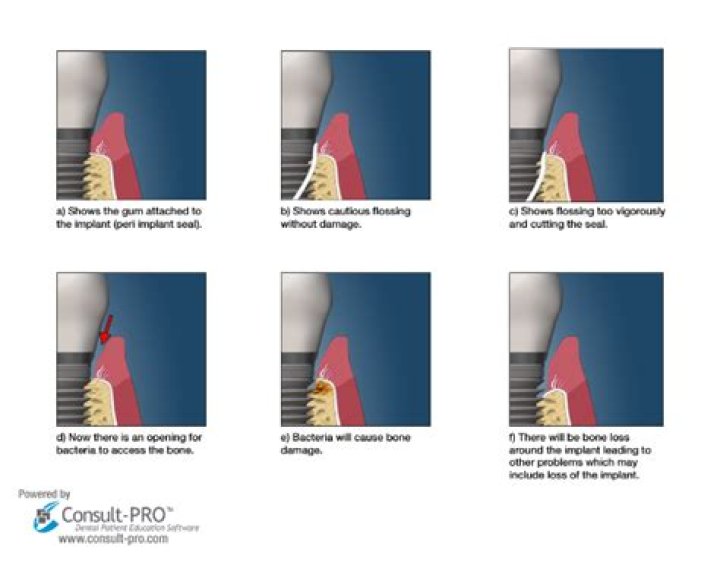 How do you floss around dental implants?