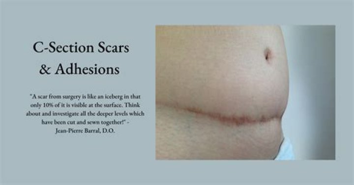 How do you get rid of internal scar tissue after C-section?