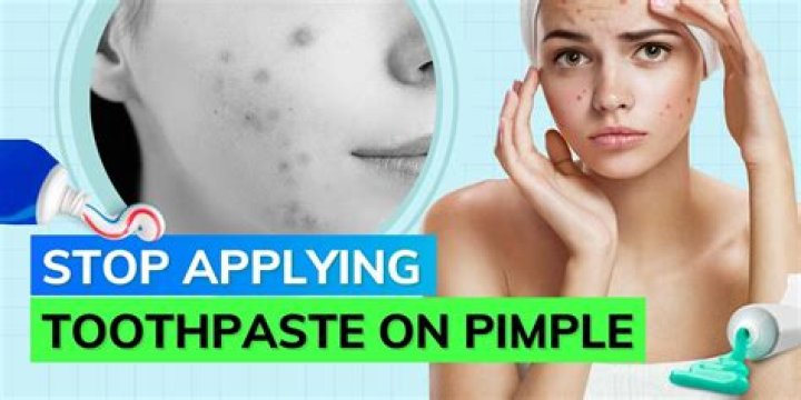How do you get rid of pimples in 5 minutes with toothpaste?