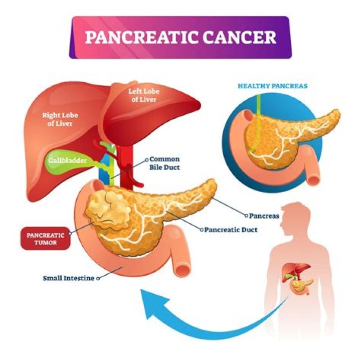 How do you know if you need pancreatic enzymes?