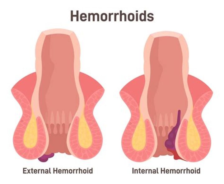 How do you sit with an external hemorrhoid?