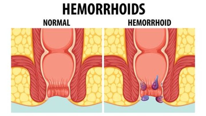 How do you tell if you have hemorrhoids or fissures?