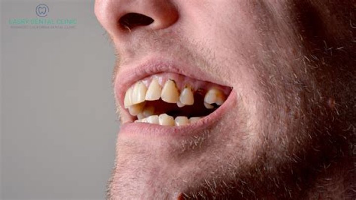 How long can you live with rotten teeth?