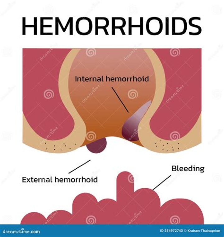 How long do thrombosed external hemorrhoids last?