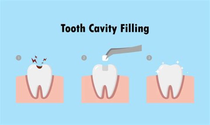 How long does a tooth filling take?
