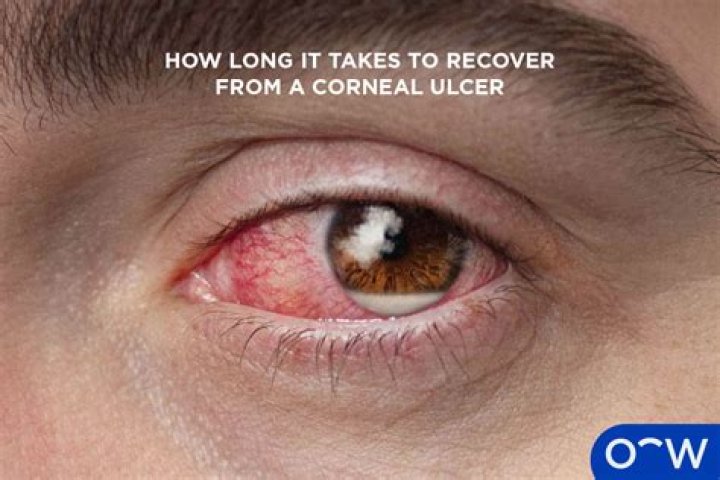 How long does corneal clouding last?