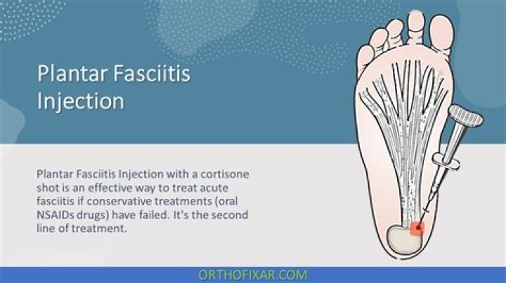 How long does it take for a cortisone shot to help plantar fasciitis?