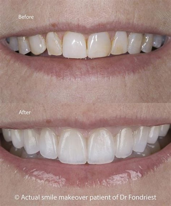How long does veneer bonding last?