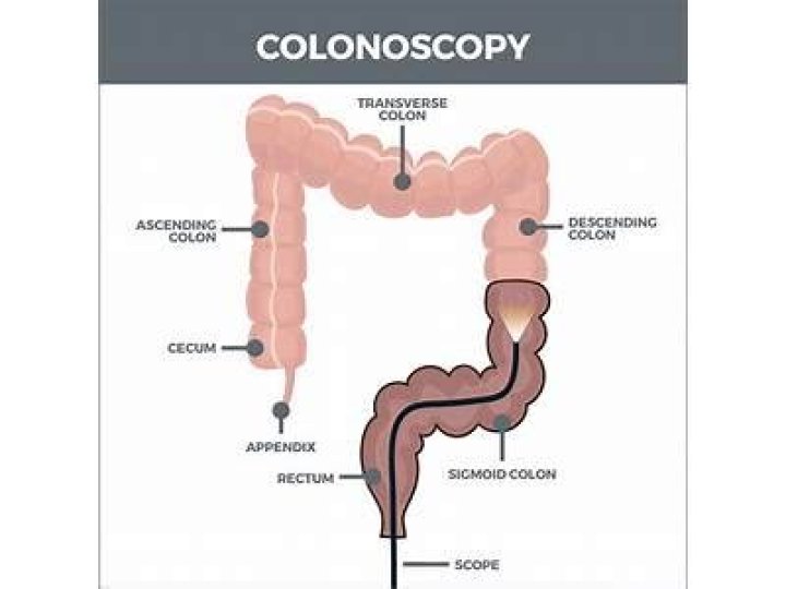 How painful is a colonoscopy?