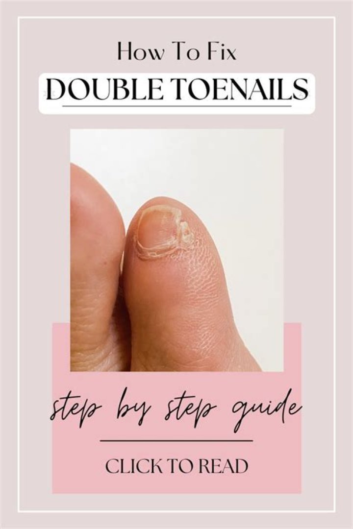 How rare is a double toenail?