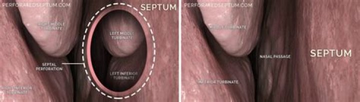 How serious is a perforated septum?
