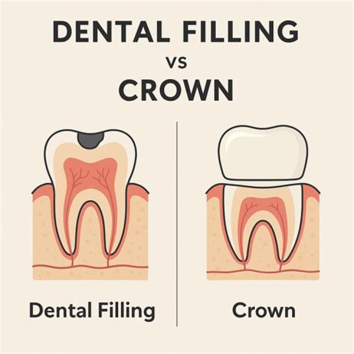 Is a filling better than a crown?