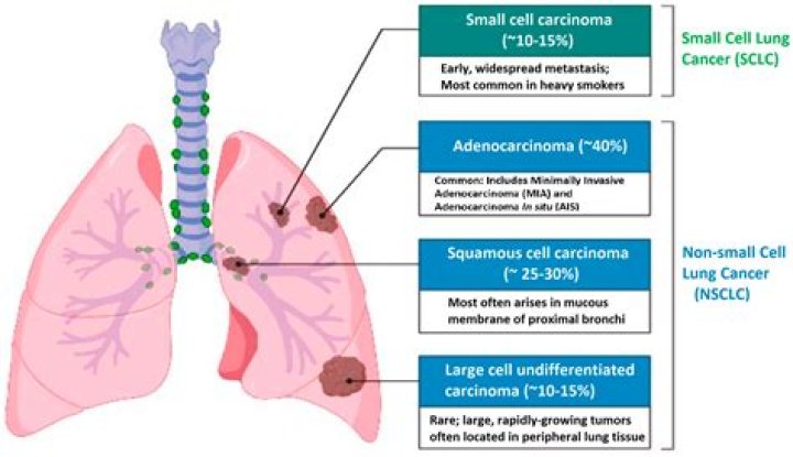 Is adenocarcinoma cancerous?