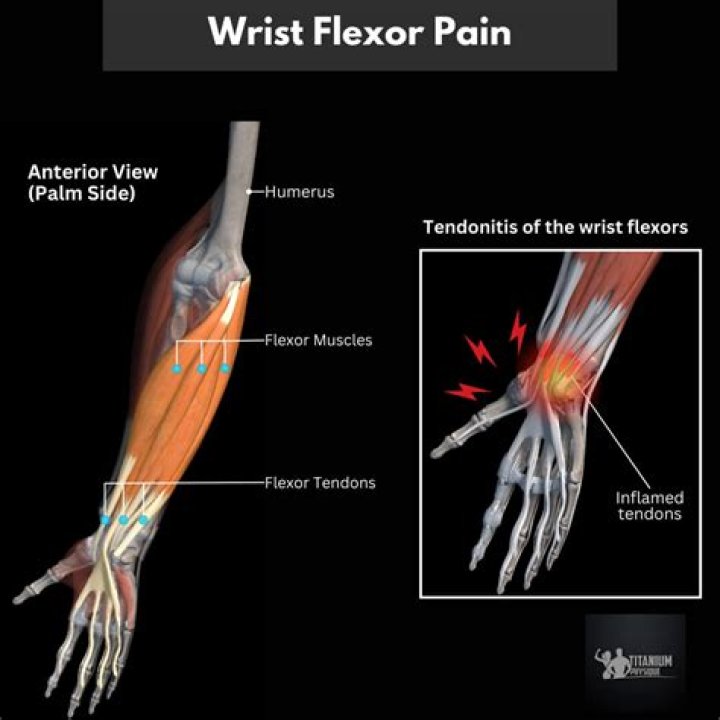 Is chronic wrist pain a disability?