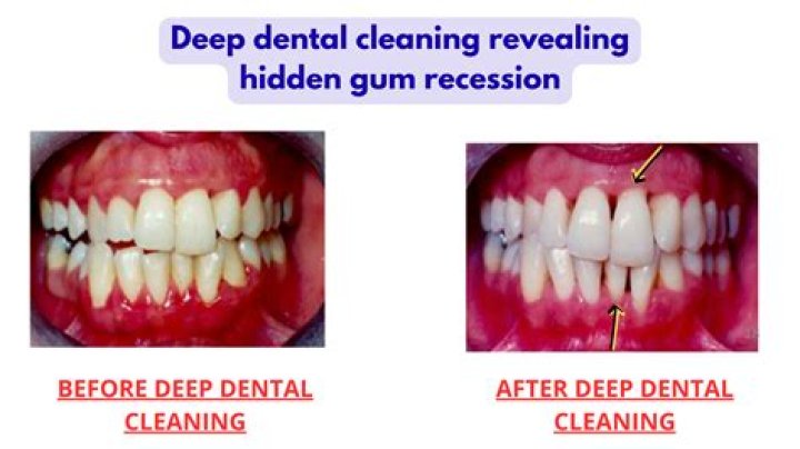 Is deep cleaning of gums necessary?