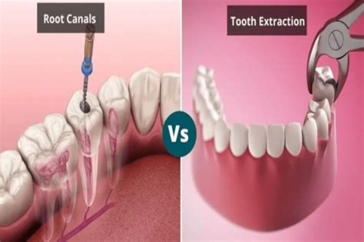 Is it better to get a root canal or extraction?