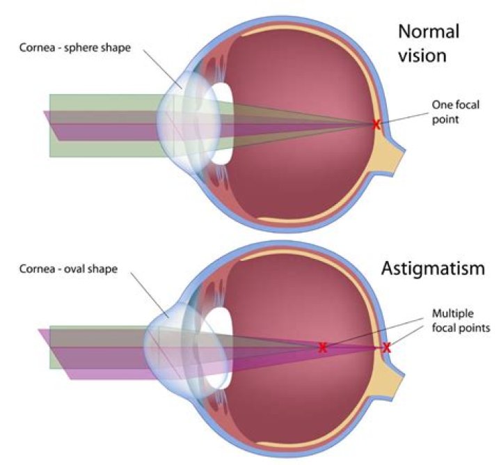 Is it normal for vision to fluctuate after LASIK?