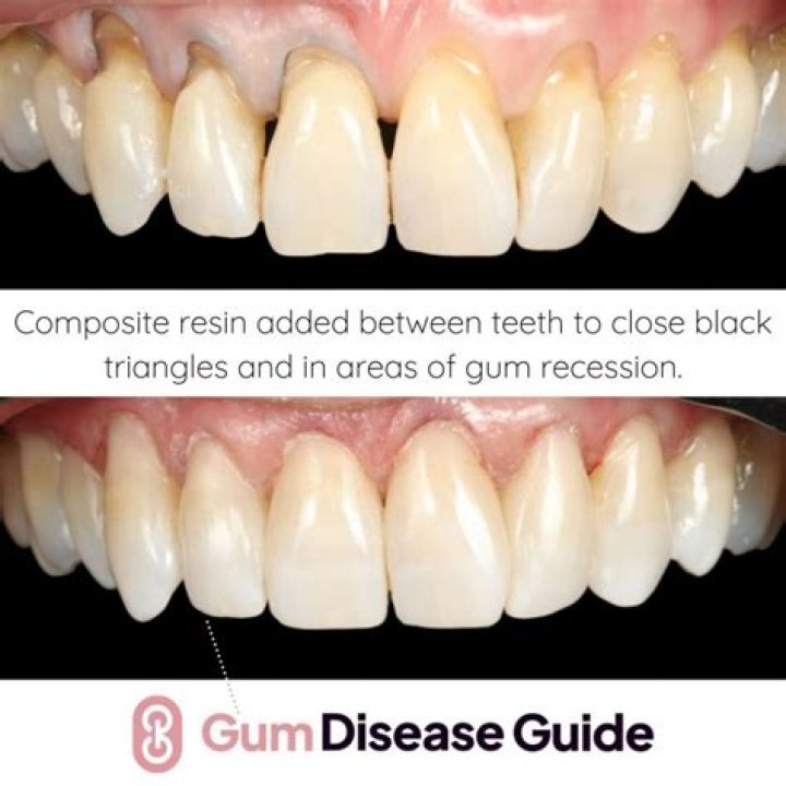 Is it possible to reverse gum damage?