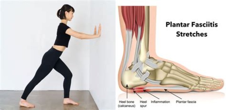 Is plantar fasciitis serious?