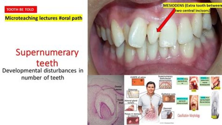 Is supernumerary teeth genetic?