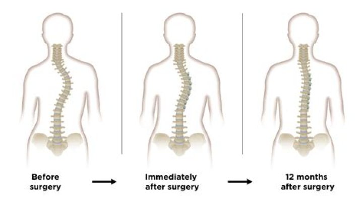 Is surgery needed for PID?