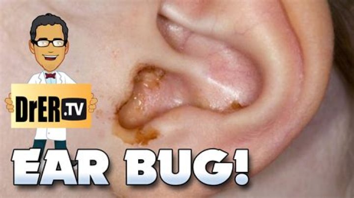 Is there a bug in my ear?
