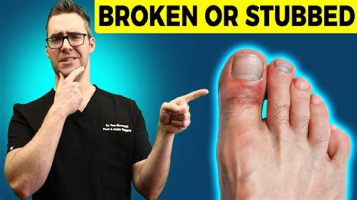 Should you ice a stubbed toe?