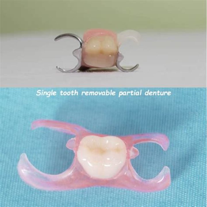 What are clip in dentures called?