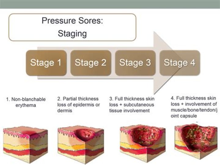 What are the 6 stages of infection?
