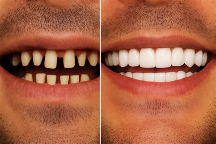 What are the risks of veneers?