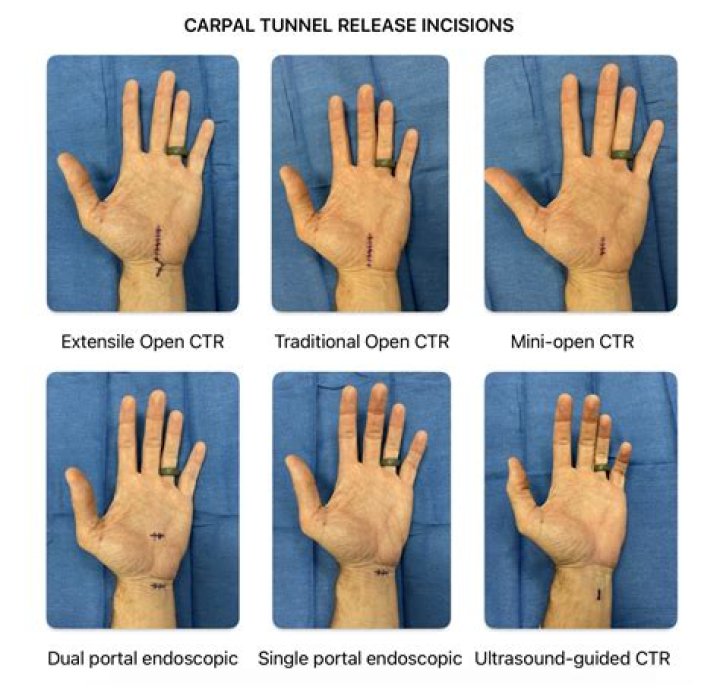 What are the stages of carpal tunnel?