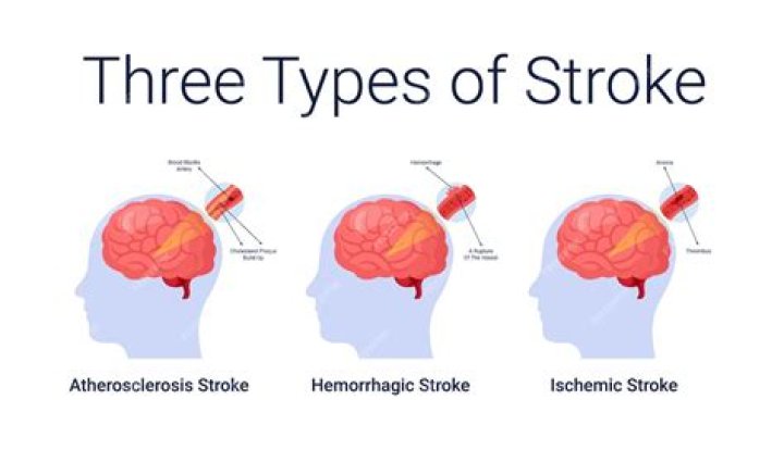 What are the three main causes of strokes?