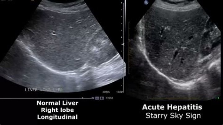 What can a liver ultrasound show?