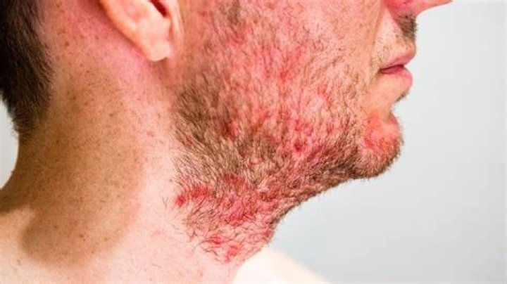 What causes pseudofolliculitis barbae?