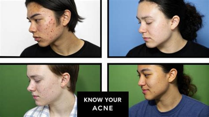 What causes teenage acne?