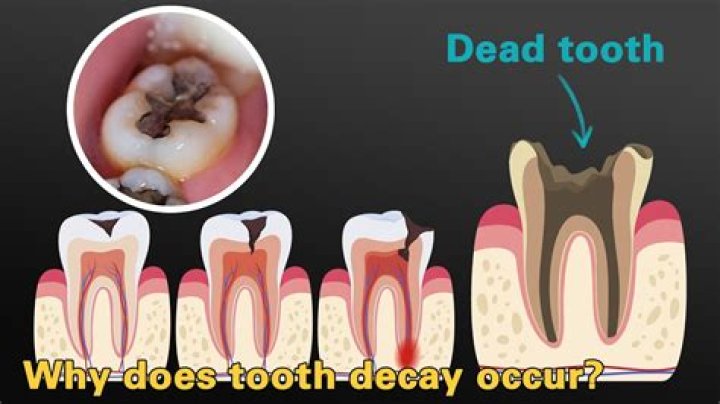 What does a dying tooth feel like?