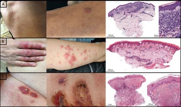 What does leukemia look like on skin?