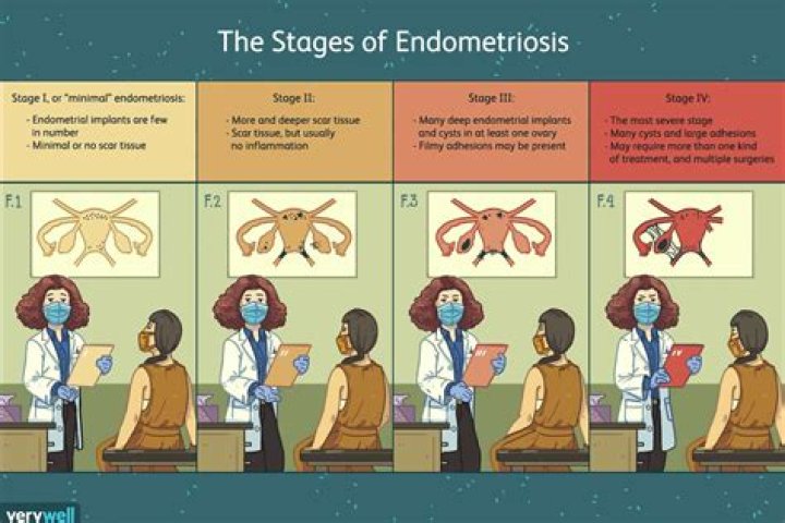 What does Stage 4 endometriosis mean?