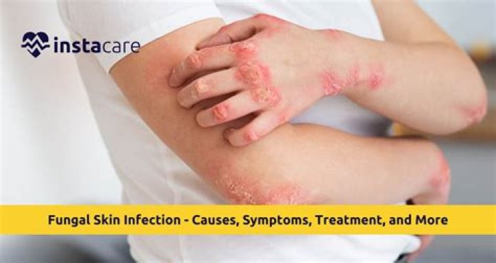 What food causes fungal infection?