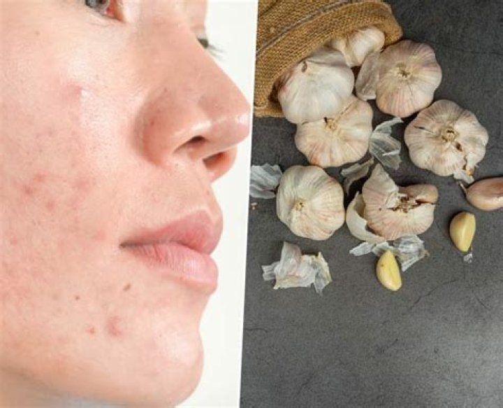 What happens if we apply garlic on face?