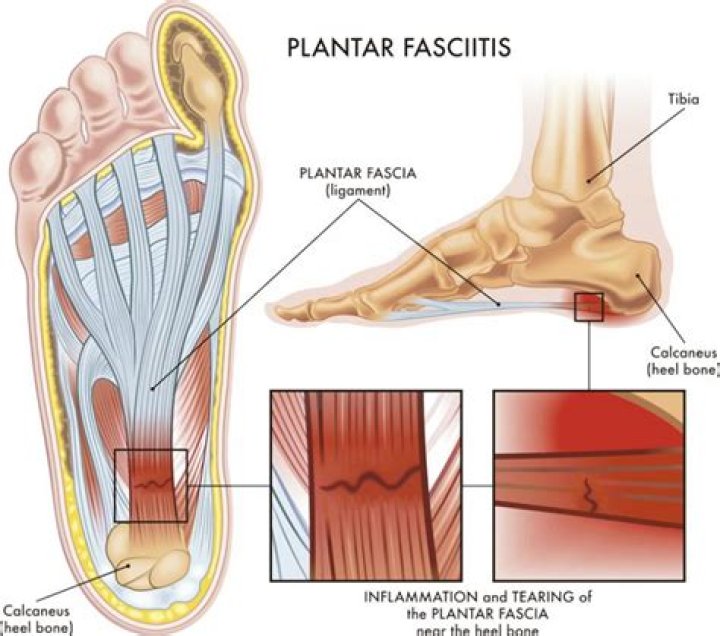 What happens if you ignore plantar fasciitis?