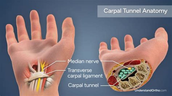 What happens if you let carpal tunnel go untreated?