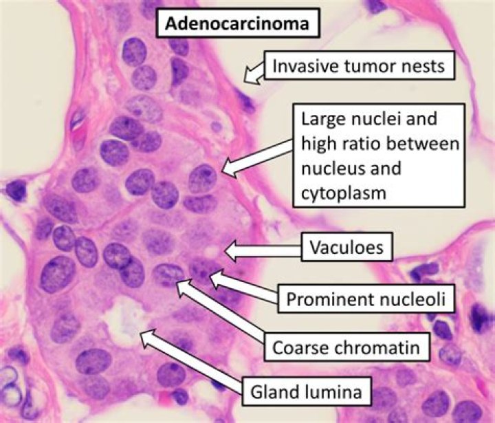 What is adenocarcinoma caused by?
