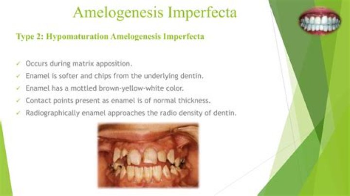 What is Amelogenesis imperfecta?