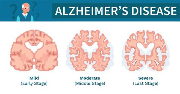 What is stage 5 Alzheimer's?