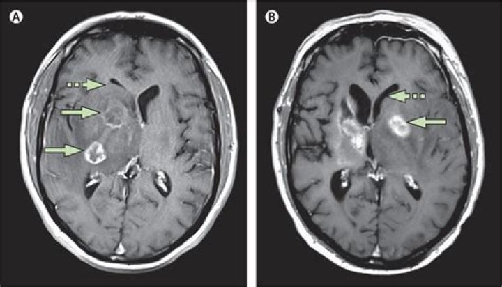 What is toxoplasmosis of the brain?